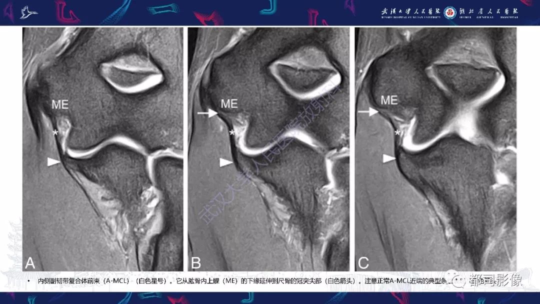 【PPT】肝脏血管肉瘤影像诊断