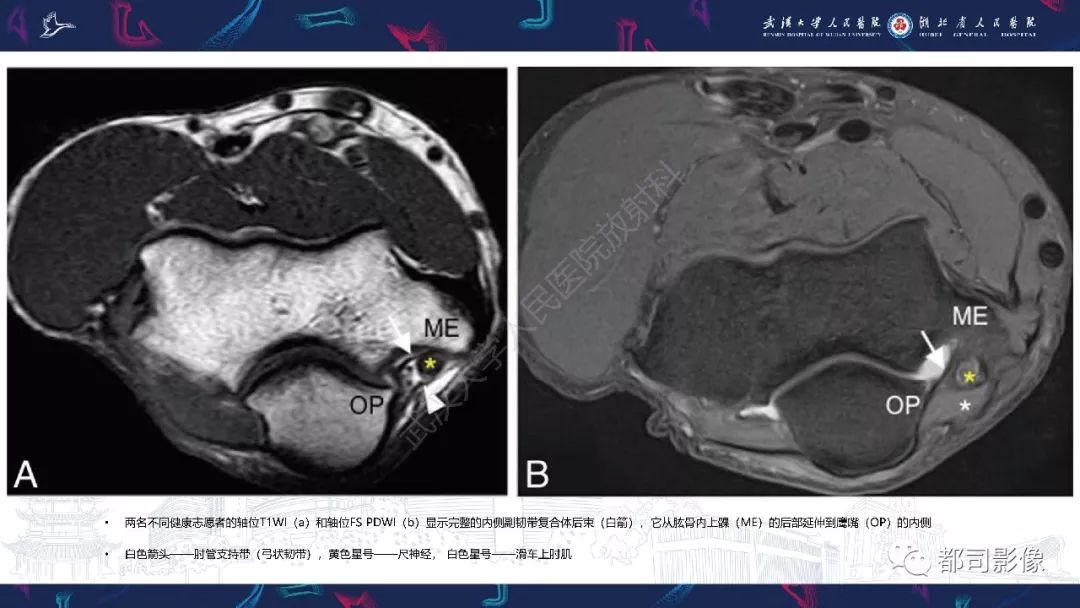 【PPT】肝脏血管肉瘤影像诊断