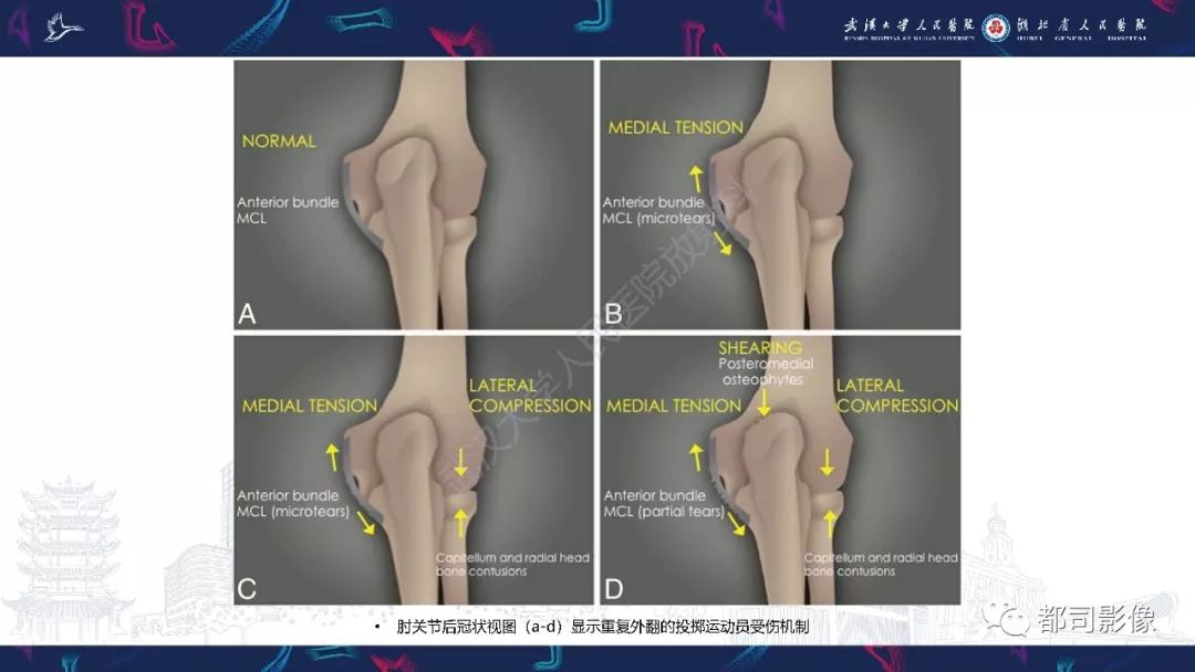 【PPT】肝脏血管肉瘤影像诊断