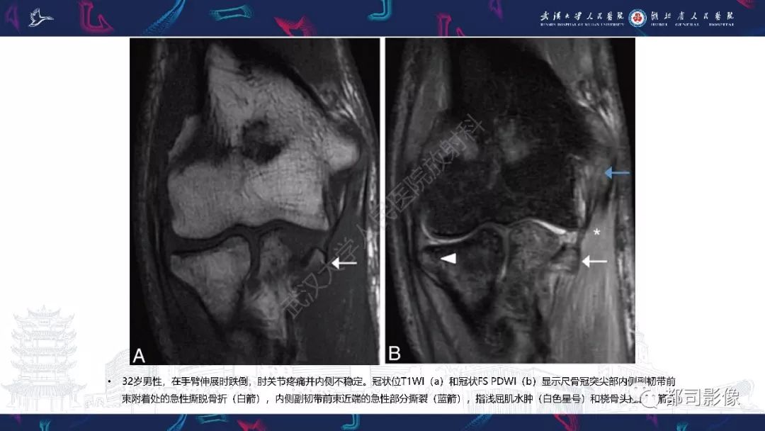 【PPT】肝脏血管肉瘤影像诊断