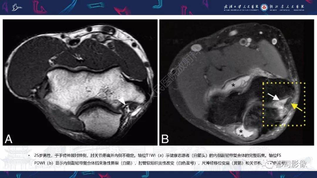 【PPT】肝脏血管肉瘤影像诊断