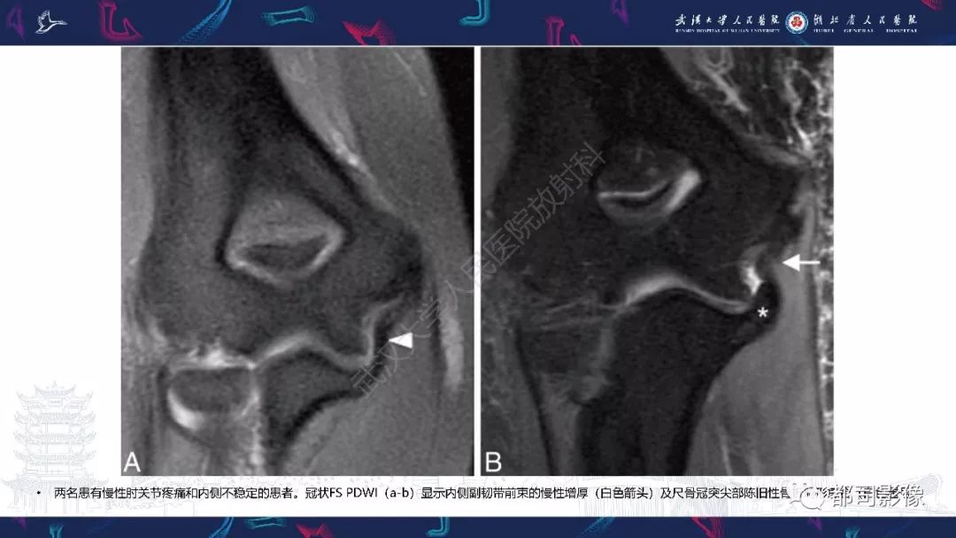 【PPT】肝脏血管肉瘤影像诊断