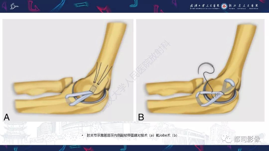 【PPT】肝脏血管肉瘤影像诊断