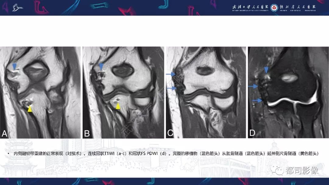 【PPT】肝脏血管肉瘤影像诊断