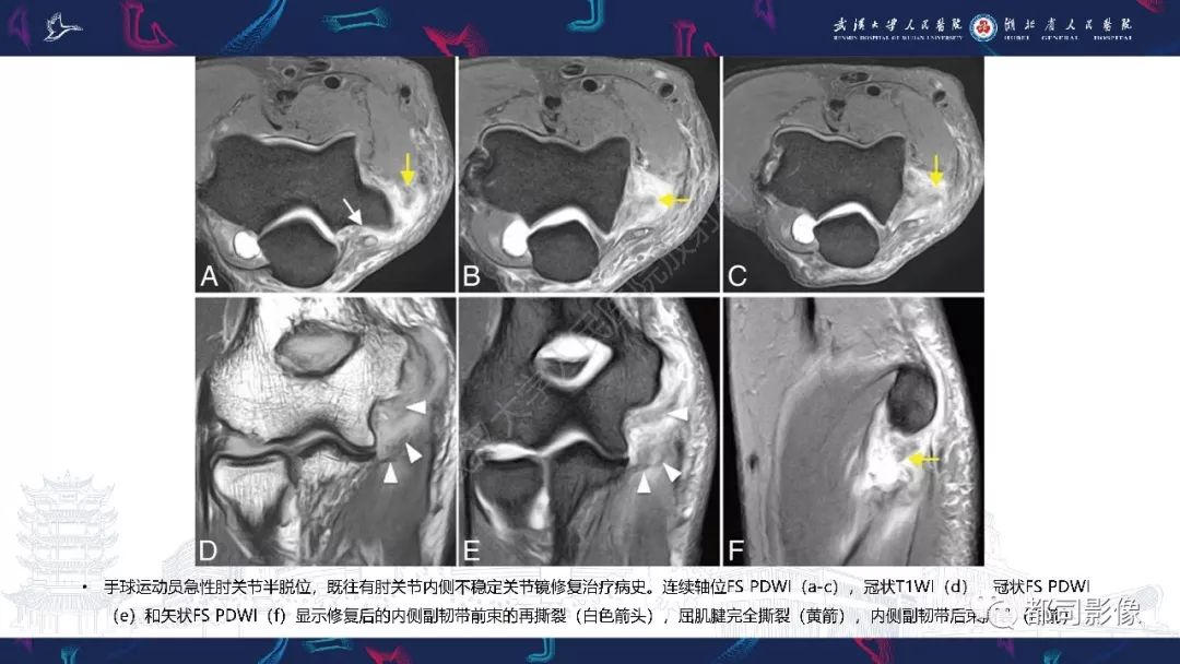 【PPT】肝脏血管肉瘤影像诊断