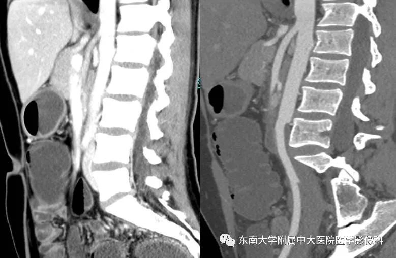 【病例】肠系膜上动脉压迫综合征1例CT影像