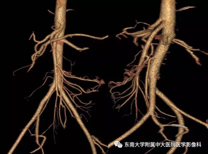 【病例】肠系膜上动脉压迫综合征1例CT影像