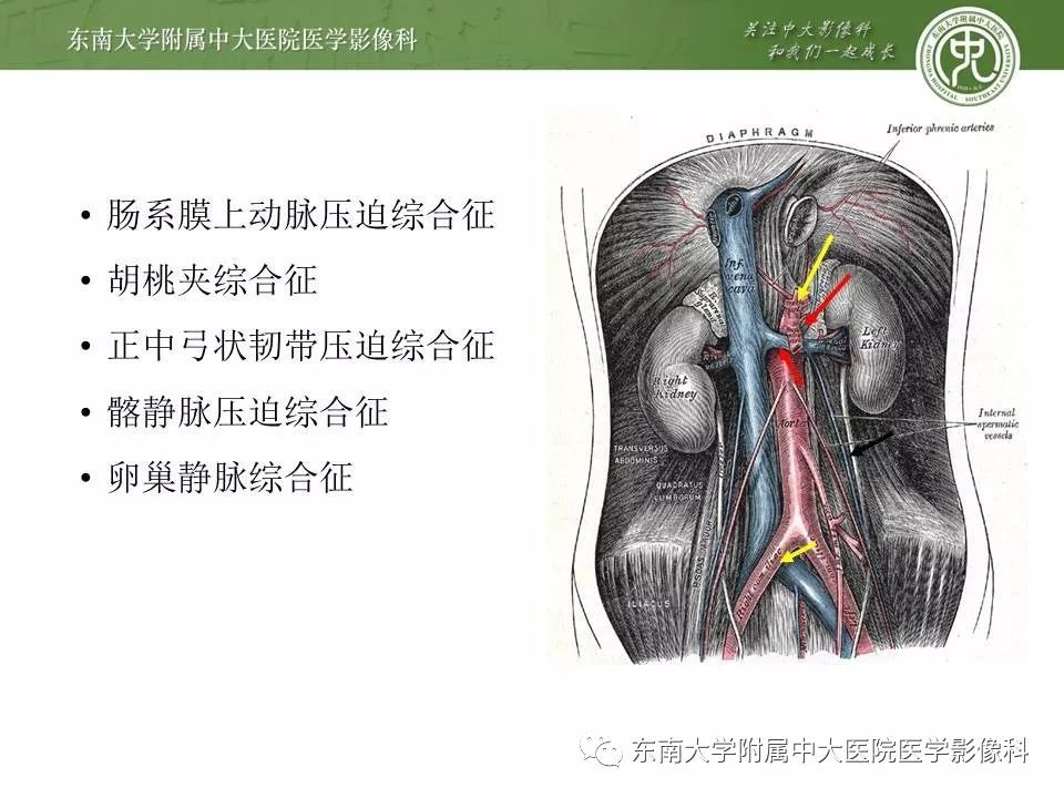 【病例】肠系膜上动脉压迫综合征1例CT影像