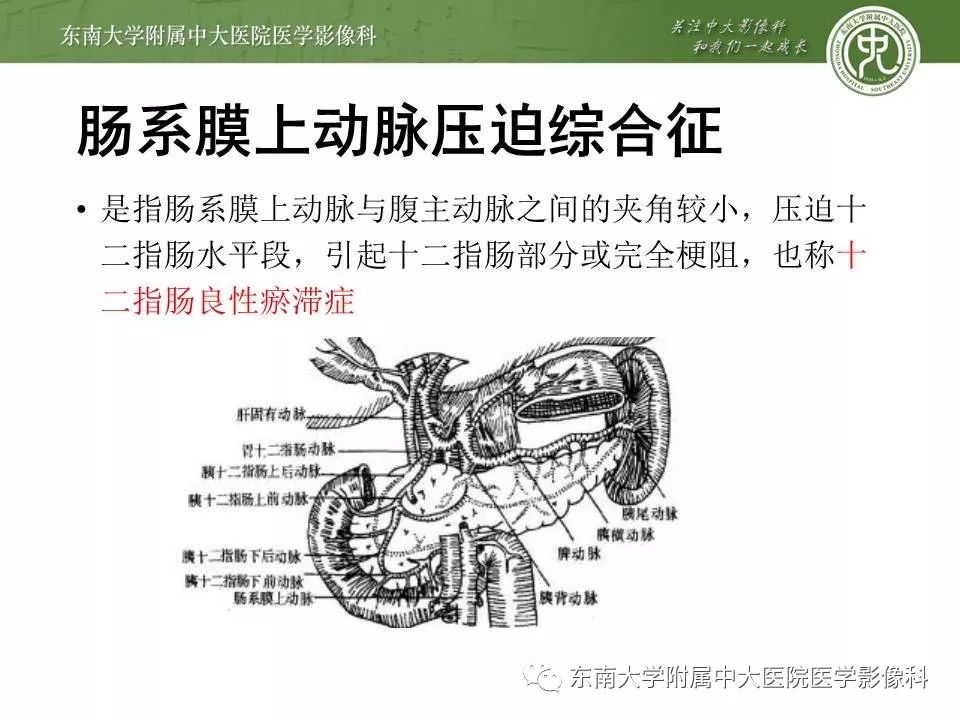 【病例】肠系膜上动脉压迫综合征1例CT影像