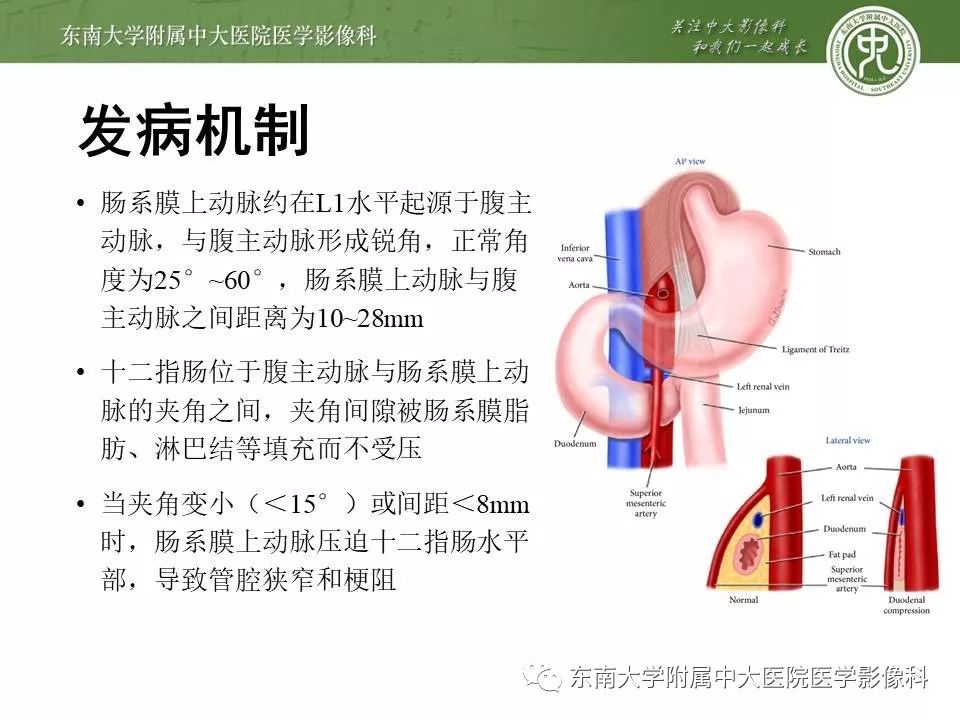 【病例】肠系膜上动脉压迫综合征1例CT影像