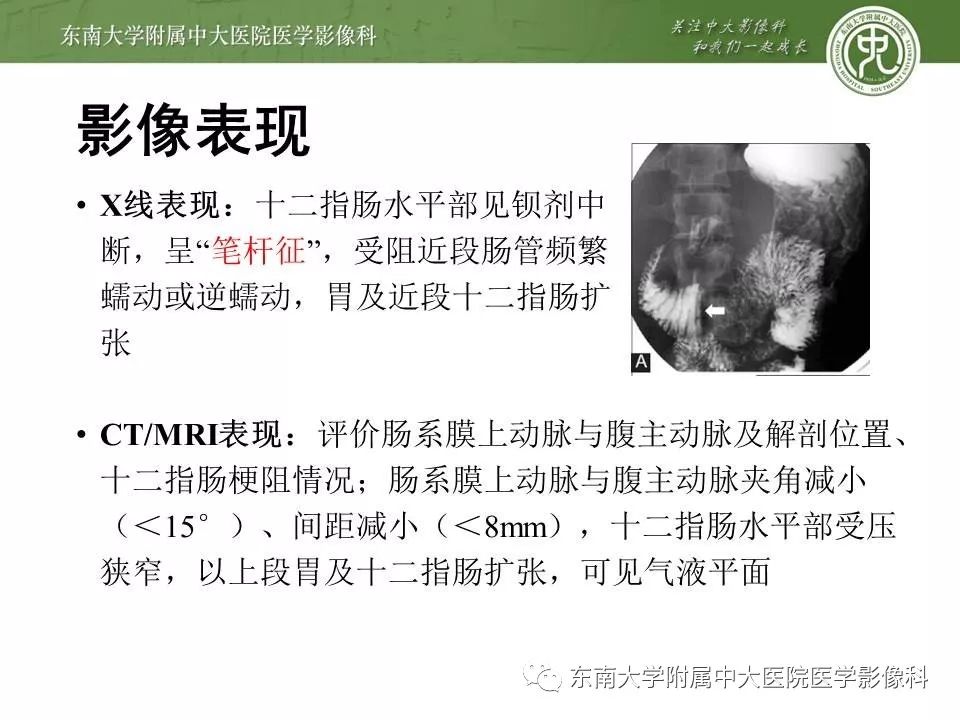 【病例】肠系膜上动脉压迫综合征1例CT影像