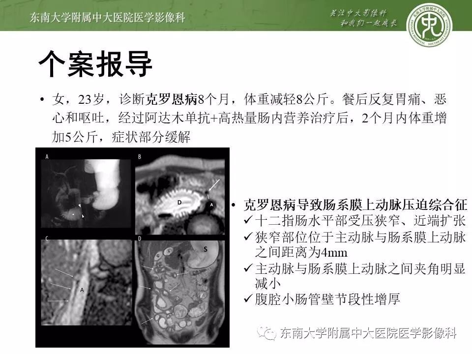 【病例】肠系膜上动脉压迫综合征1例CT影像