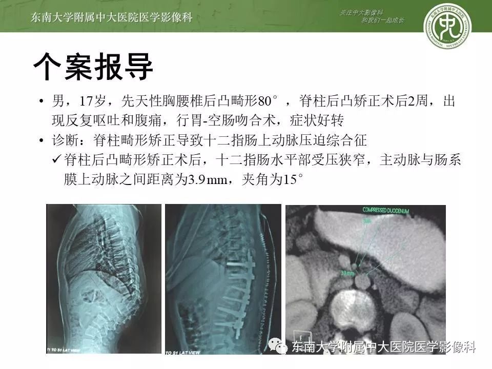 【病例】肠系膜上动脉压迫综合征1例CT影像