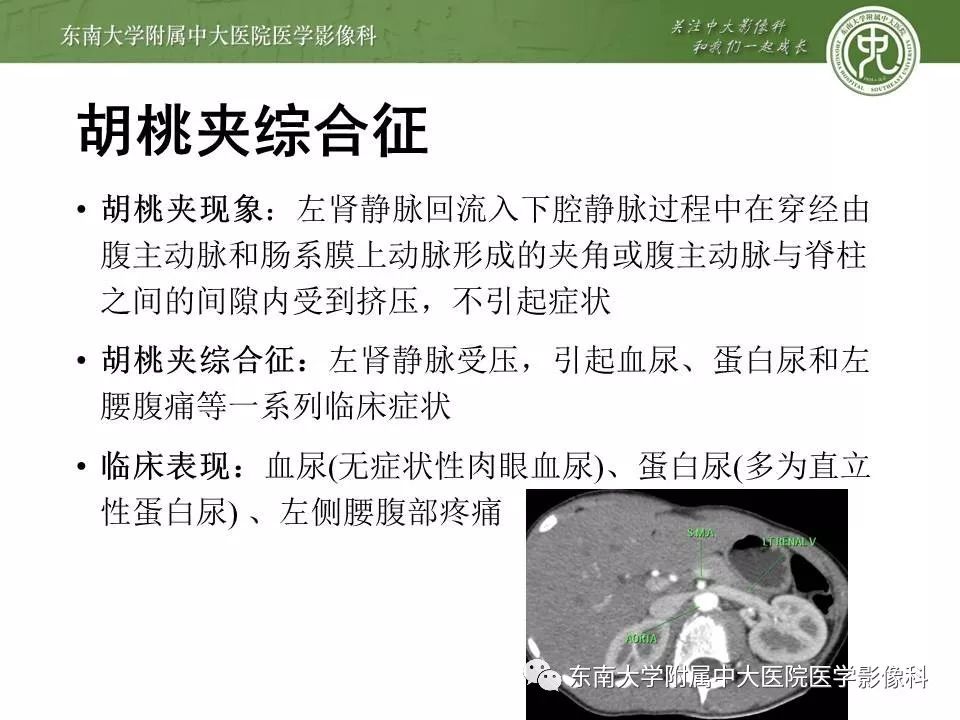 【病例】肠系膜上动脉压迫综合征1例CT影像