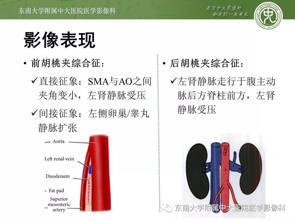 【病例】肠系膜上动脉压迫综合征1例CT影像