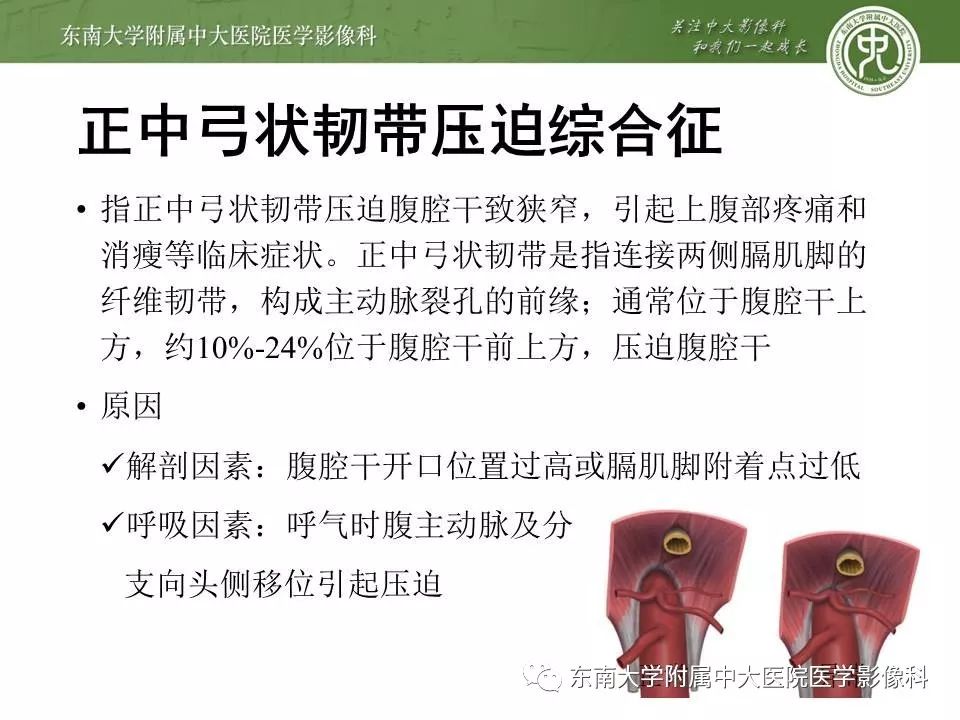 【病例】肠系膜上动脉压迫综合征1例CT影像