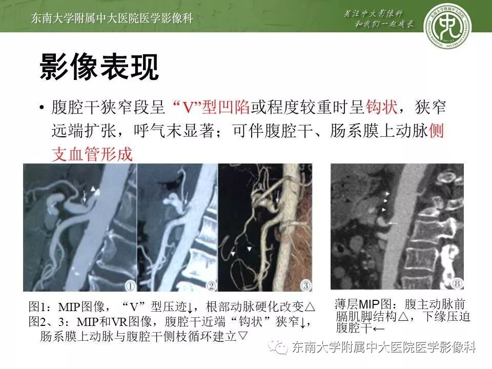 【病例】肠系膜上动脉压迫综合征1例CT影像