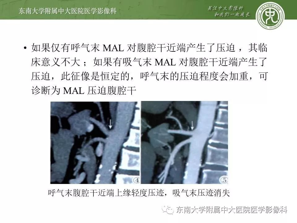 【病例】肠系膜上动脉压迫综合征1例CT影像