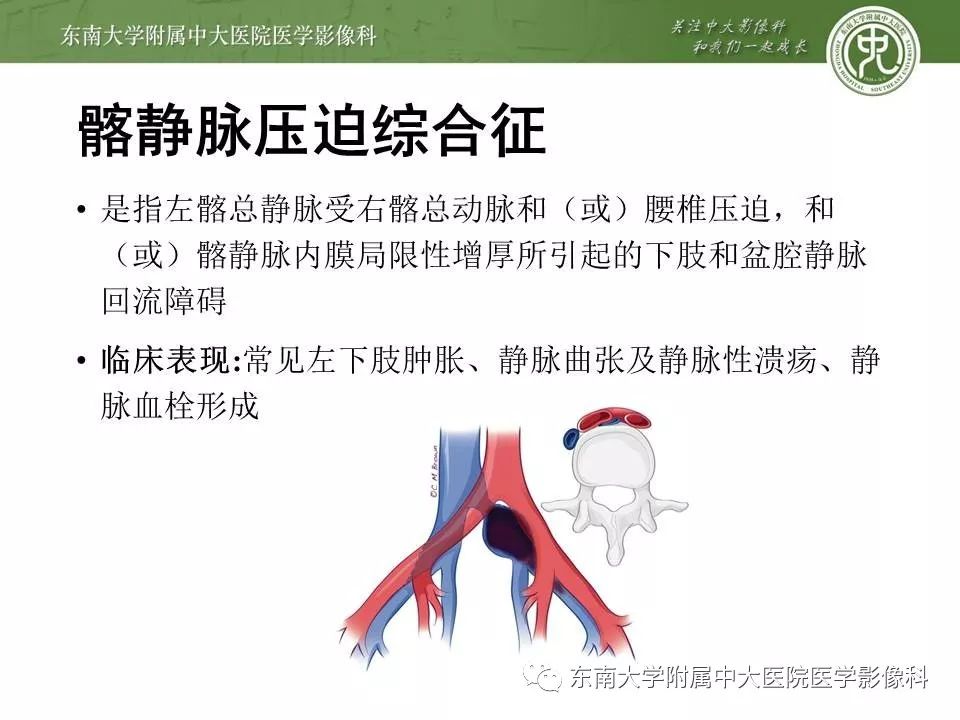 【病例】肠系膜上动脉压迫综合征1例CT影像