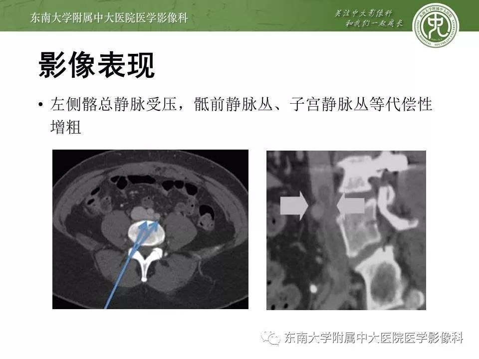 【病例】肠系膜上动脉压迫综合征1例CT影像