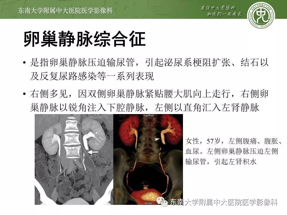 【病例】肠系膜上动脉压迫综合征1例CT影像