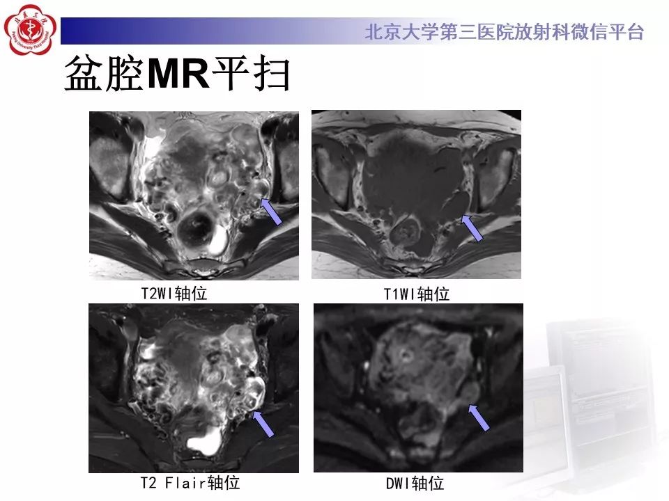 【病例】静脉内平滑肌瘤病1例CT及MR影像