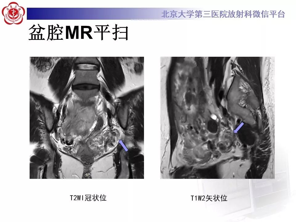 【病例】静脉内平滑肌瘤病1例CT及MR影像