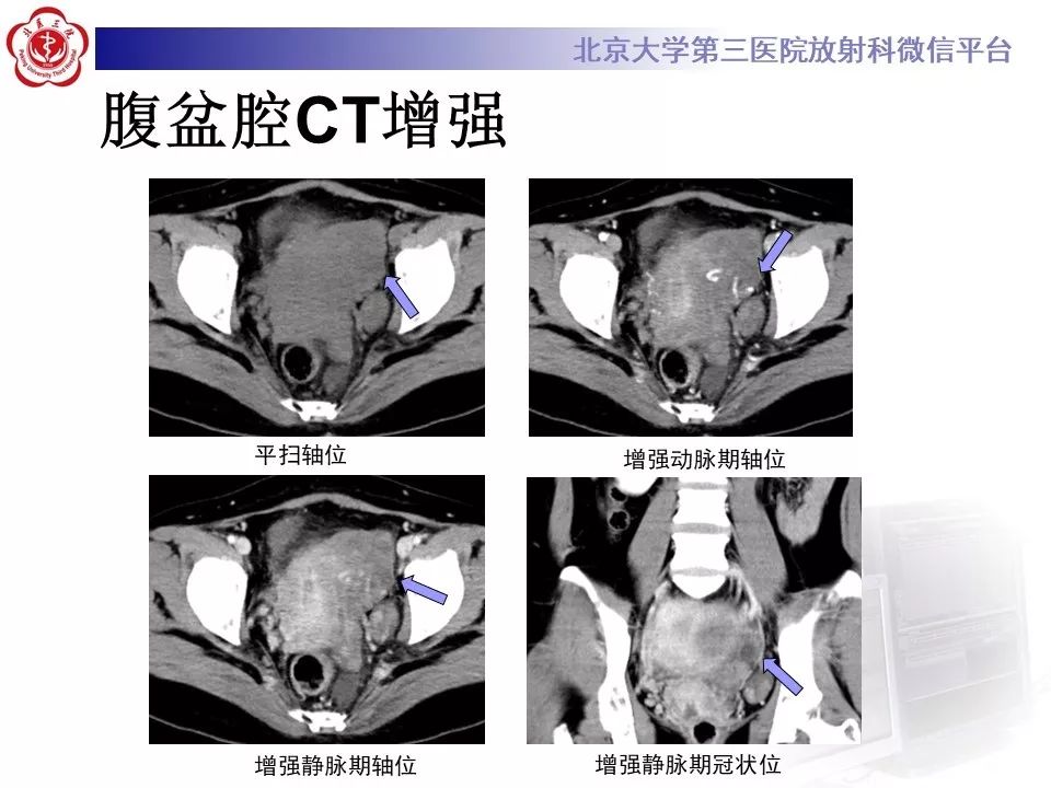 【病例】静脉内平滑肌瘤病1例CT及MR影像
