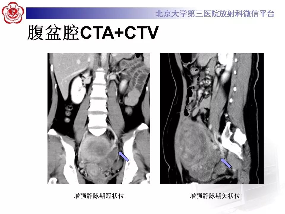 【病例】静脉内平滑肌瘤病1例CT及MR影像