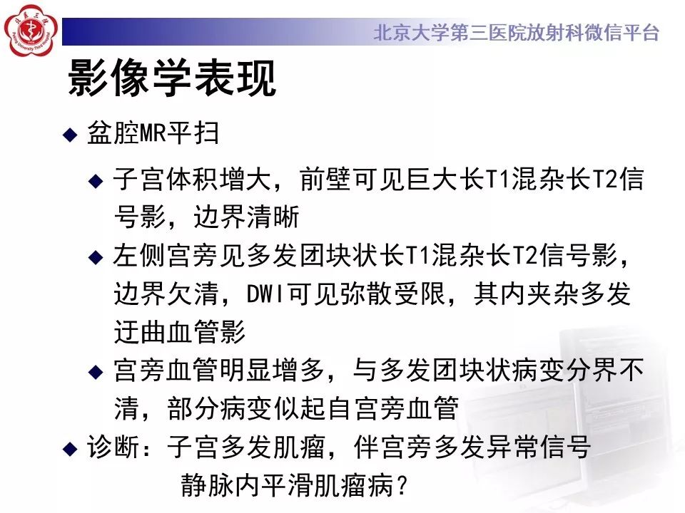 【病例】静脉内平滑肌瘤病1例CT及MR影像