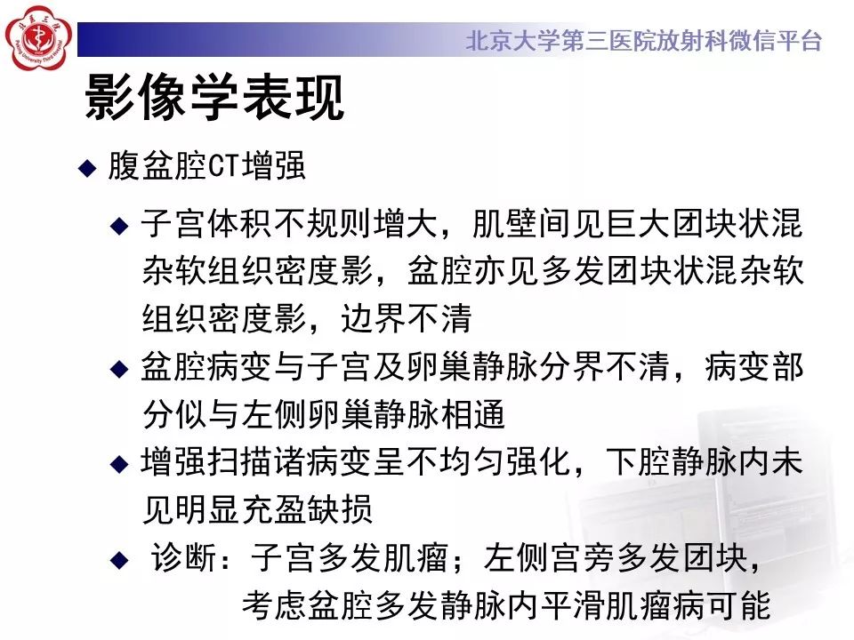 【病例】静脉内平滑肌瘤病1例CT及MR影像