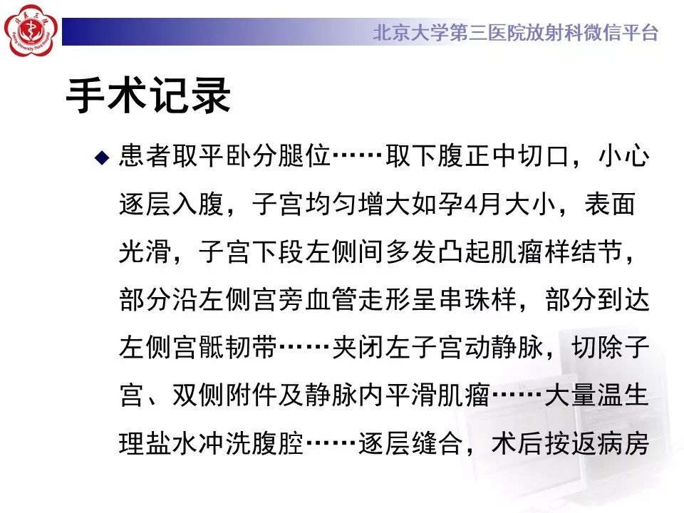 【病例】静脉内平滑肌瘤病1例CT及MR影像