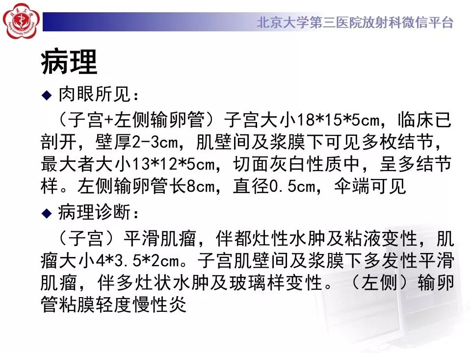 【病例】静脉内平滑肌瘤病1例CT及MR影像