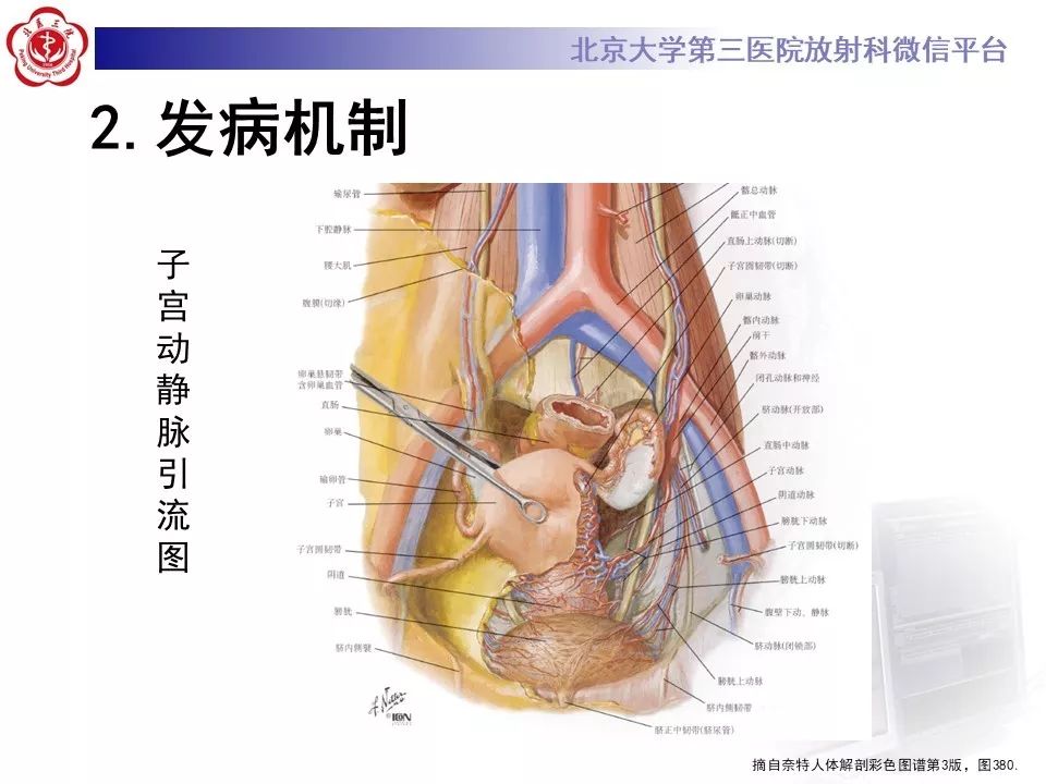【病例】静脉内平滑肌瘤病1例CT及MR影像