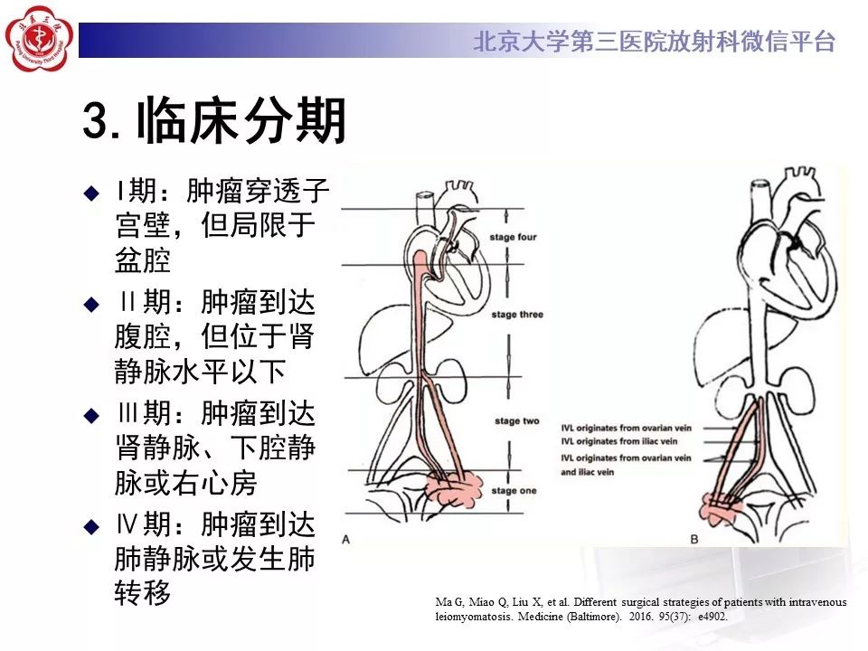 【病例】静脉内平滑肌瘤病1例CT及MR影像
