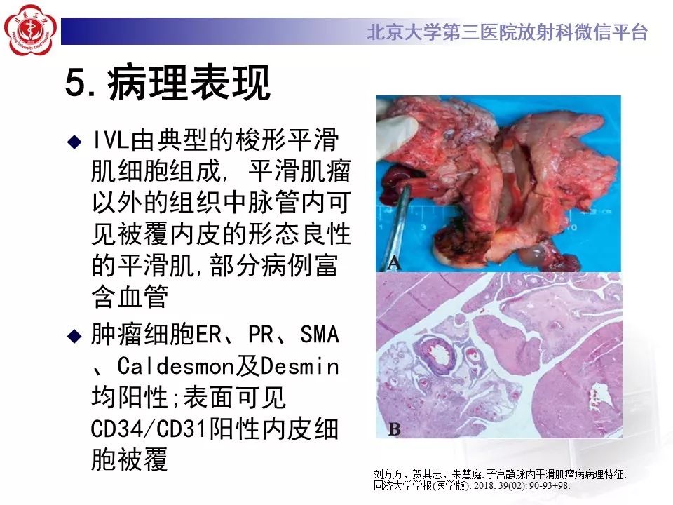 【病例】静脉内平滑肌瘤病1例CT及MR影像