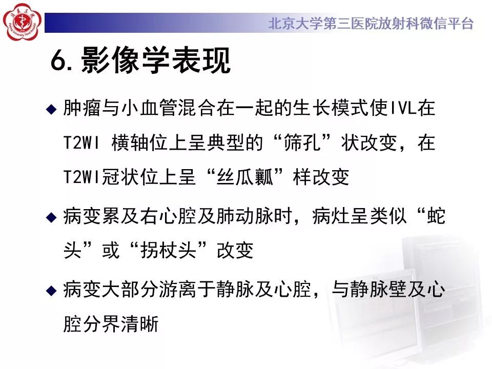 【病例】静脉内平滑肌瘤病1例CT及MR影像