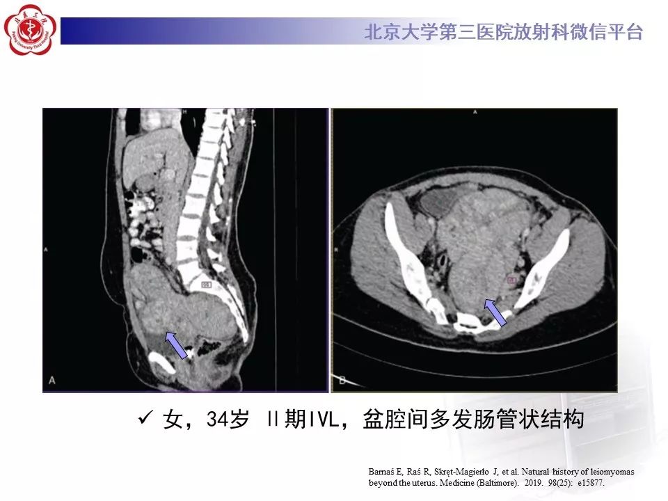 【病例】静脉内平滑肌瘤病1例CT及MR影像