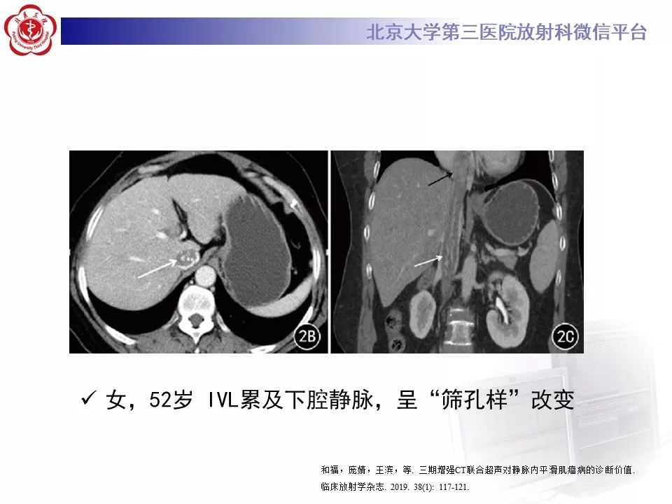 【病例】静脉内平滑肌瘤病1例CT及MR影像