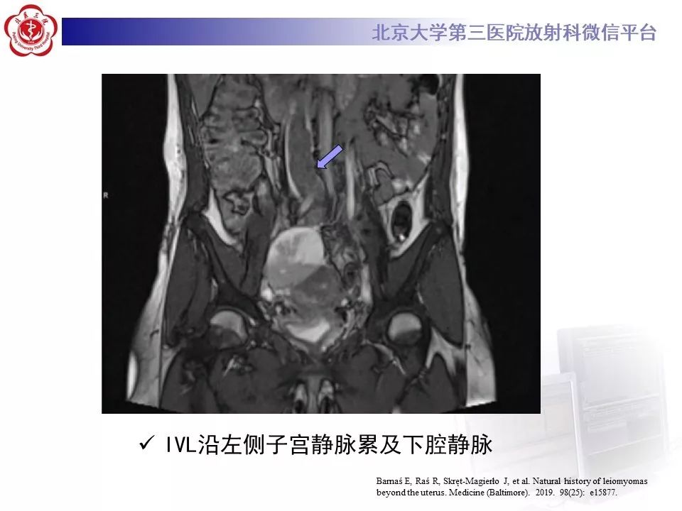 【病例】静脉内平滑肌瘤病1例CT及MR影像