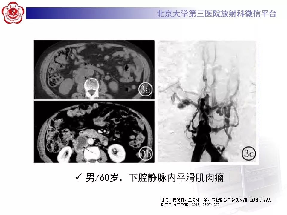 【病例】静脉内平滑肌瘤病1例CT及MR影像