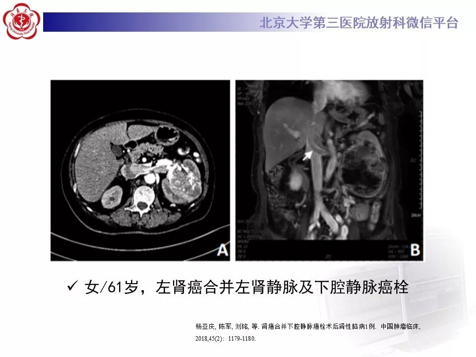 【病例】静脉内平滑肌瘤病1例CT及MR影像