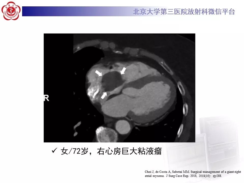 【病例】静脉内平滑肌瘤病1例CT及MR影像