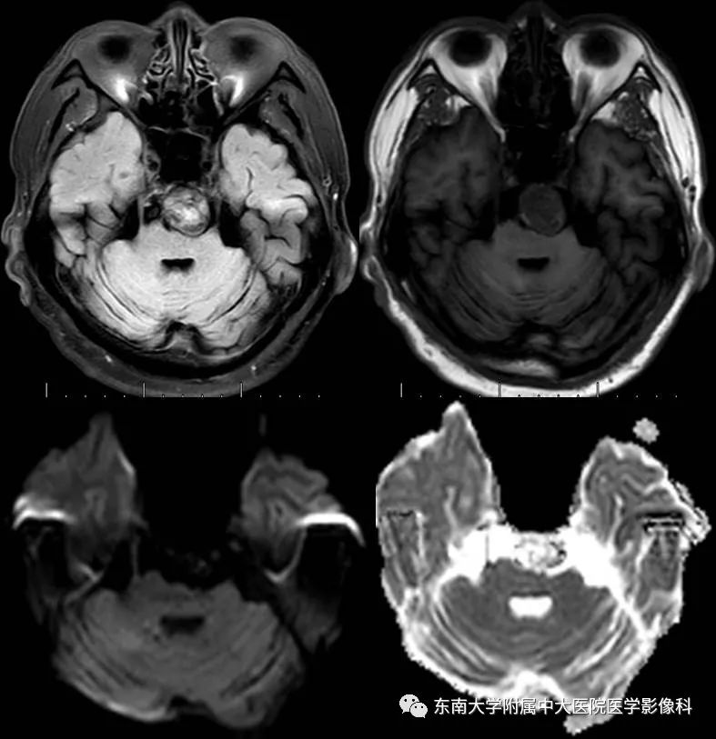 【病例】基底动脉巨大动脉瘤伴血栓形成1例CT及MR