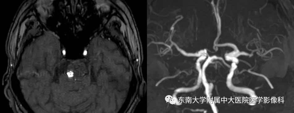 【病例】基底动脉巨大动脉瘤伴血栓形成1例CT及MR
