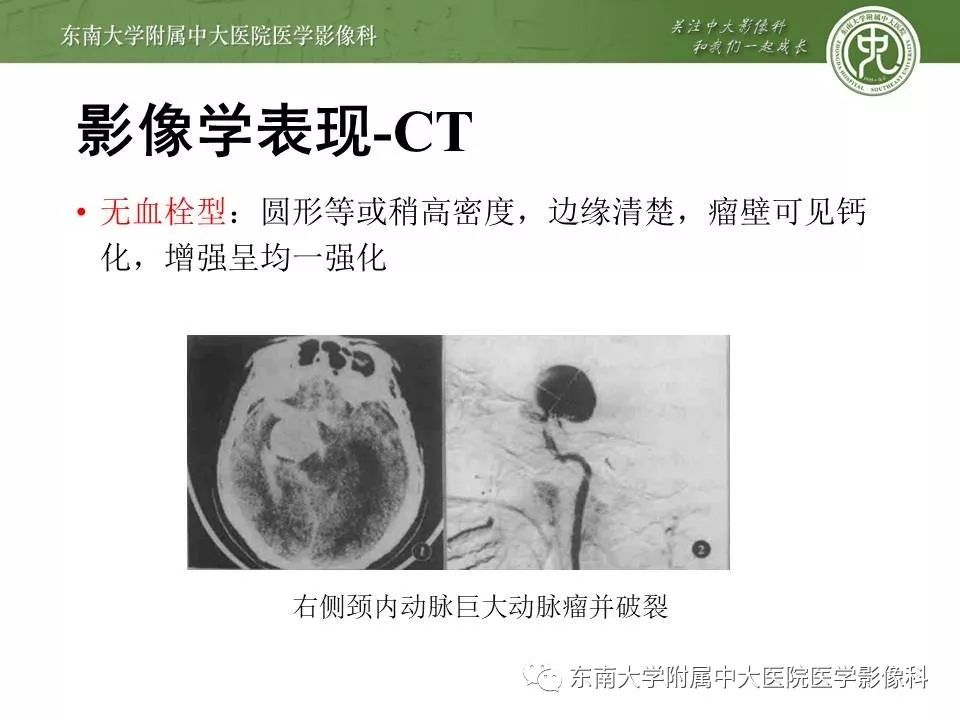 【病例】基底动脉巨大动脉瘤伴血栓形成1例CT及MR