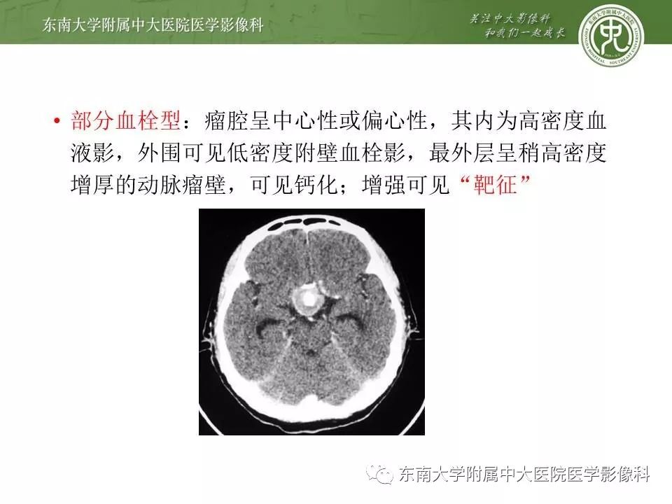 【病例】基底动脉巨大动脉瘤伴血栓形成1例CT及MR