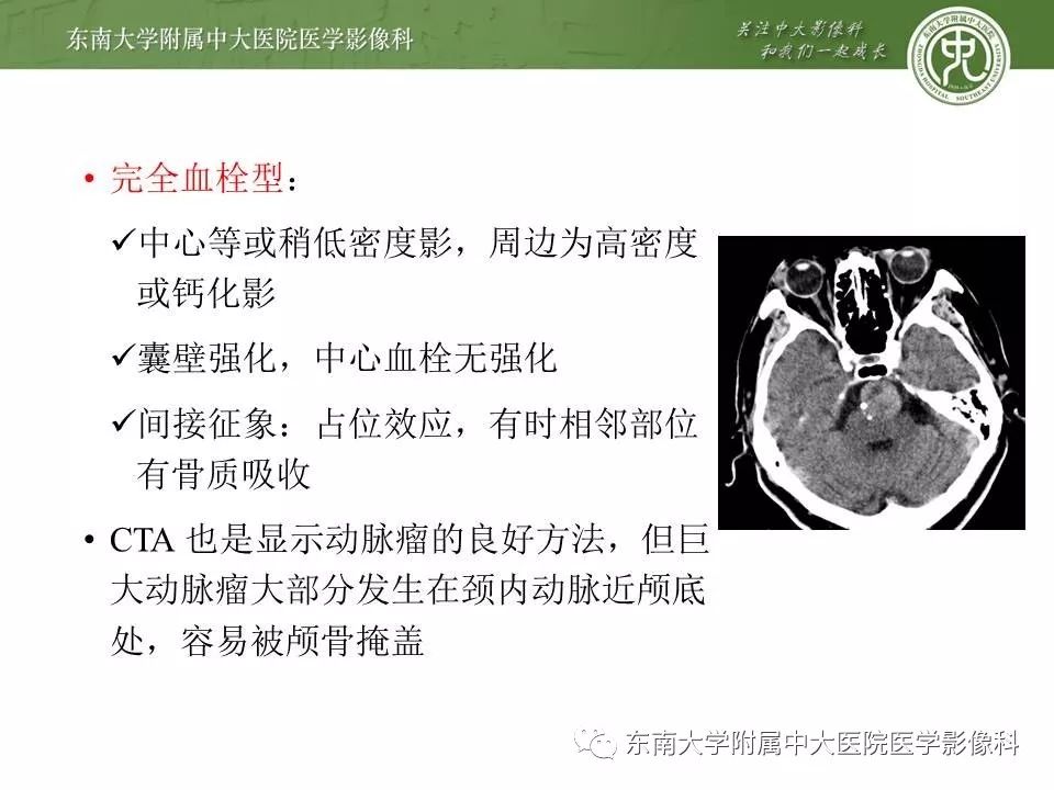 【病例】基底动脉巨大动脉瘤伴血栓形成1例CT及MR