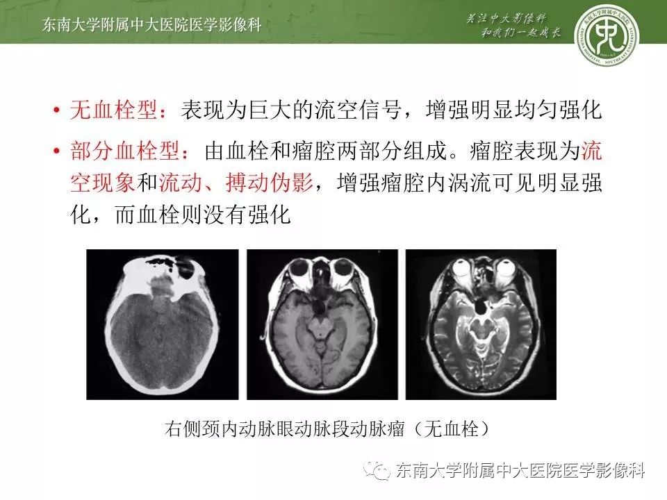 【病例】基底动脉巨大动脉瘤伴血栓形成1例CT及MR