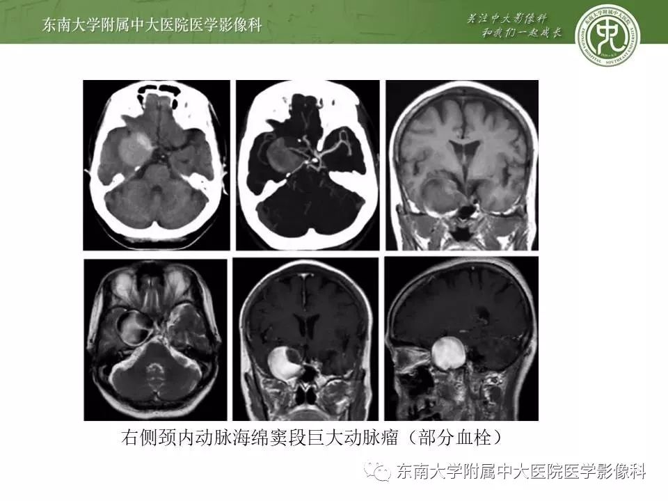 【病例】基底动脉巨大动脉瘤伴血栓形成1例CT及MR
